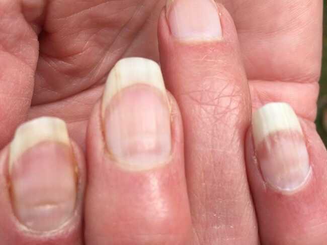 People are getting 'COVID nails,' and one expert says the unusual lines could be used as an antibody test to prove previous infection