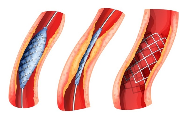 PCI Versus CABG in Multivessel CAD: Long-term Outcomes
