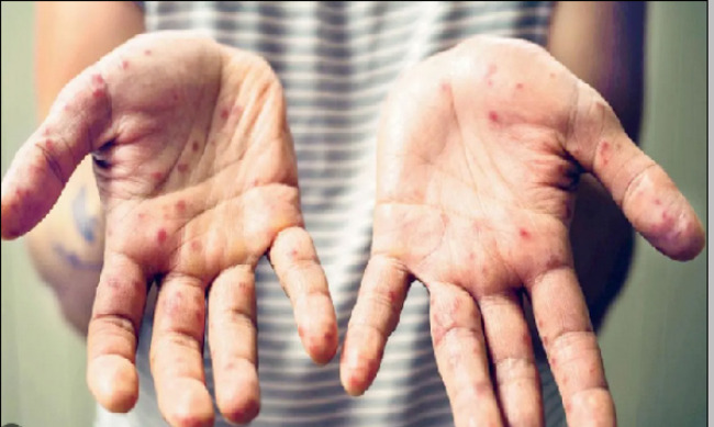 Ask the doctor: How can I avoid infecting others with chicken pox?