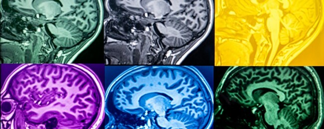 Brain study reaches milestone, revealing future of youth mental health care