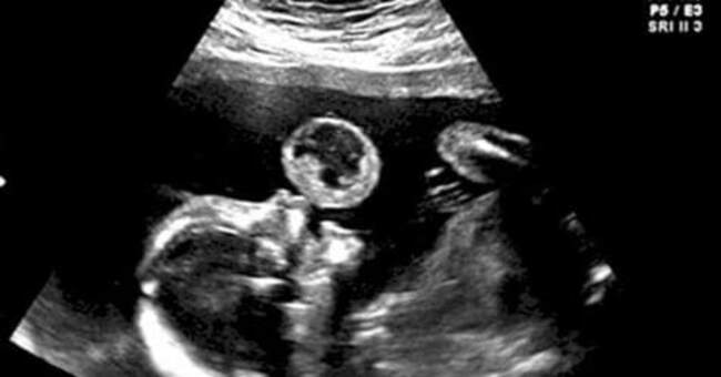 Mom Thinks Her Baby Is Blowing Bubble In Ultrasound, Then Doctors Discover What It Really Is
