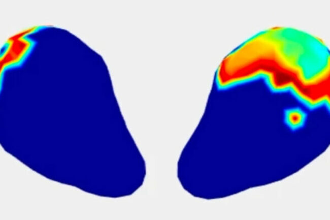 Portable, low-cost tech tracks uterine contractions