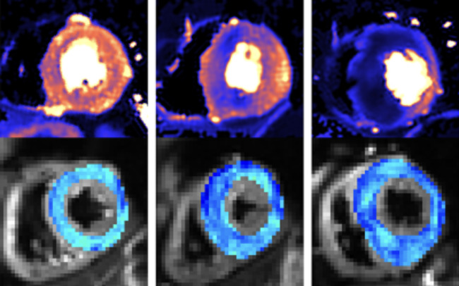 New Scanning Methods Detect Deadly Heart Condition Before Symptoms Appear