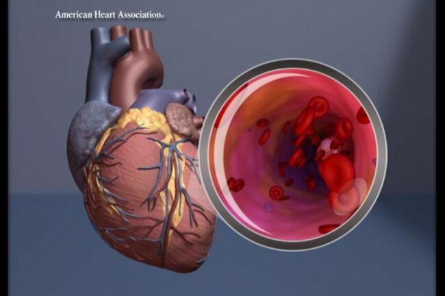 Treating Chronic Heart Disease Targets Symptom Relief, Healthy Habits