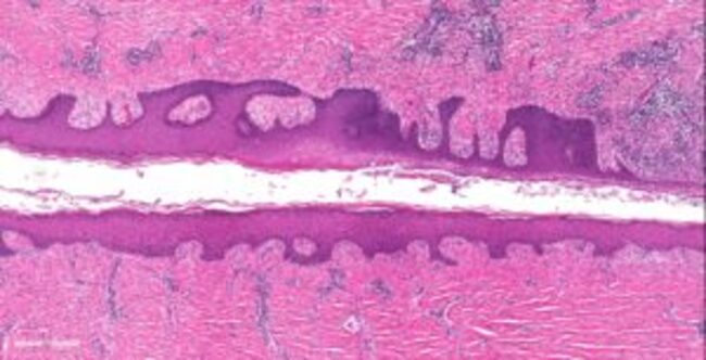 Genetic Hotspots for Hidradenitis Suppurativa Risk Found