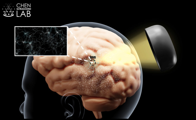 NIH Sponsors Study on Ultrasound, Genetics for Brain Disorders