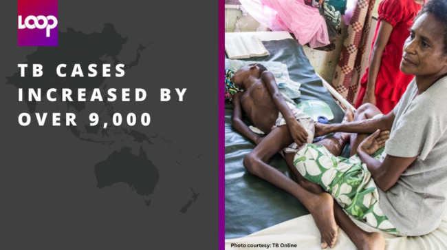 TB cases increased by over 9,000