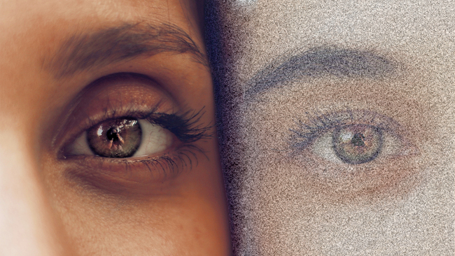 Brain Scan Reveals Potential Biological Roots of Visual Snow Syndrome