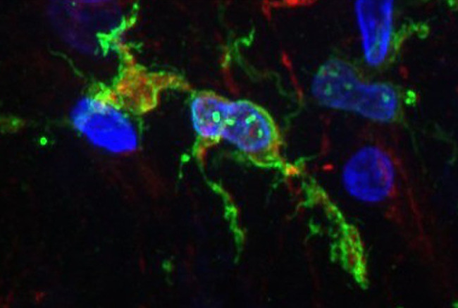 Study links changes in brain immune cells to Alzheimer's