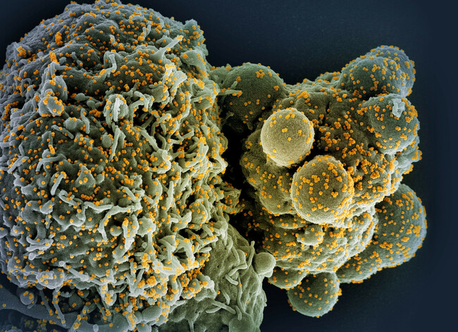 Severe Covid May Trigger Long-Term Immune System Changes