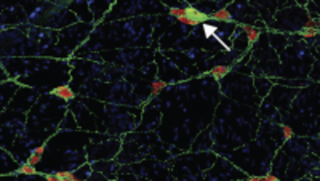Study Adds to Evidence That Parkinson's Starts in Gut