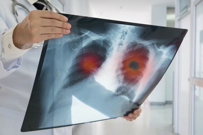 Optimizing Lung Cancer Screening with Tobacco Cessation Treatment
