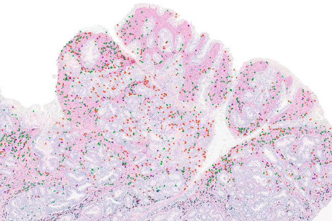 Research Reveals Why Some Immunotherapies Fall Short of Predictions
