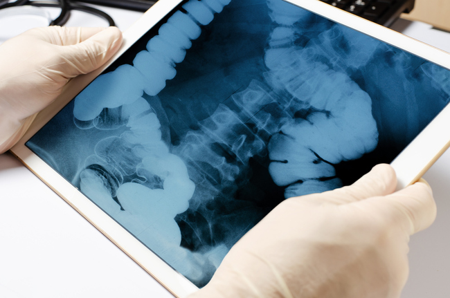 Gut Bacteria Linked to Bone Strength Identified by Scientists