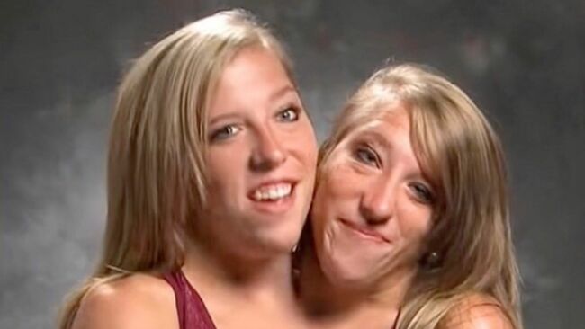 Conjoined twins Abby and Brittany Hensel respond to viral baby photos