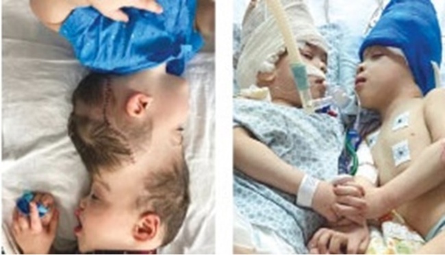 Conjoined twins separated with help of VR in Brazil