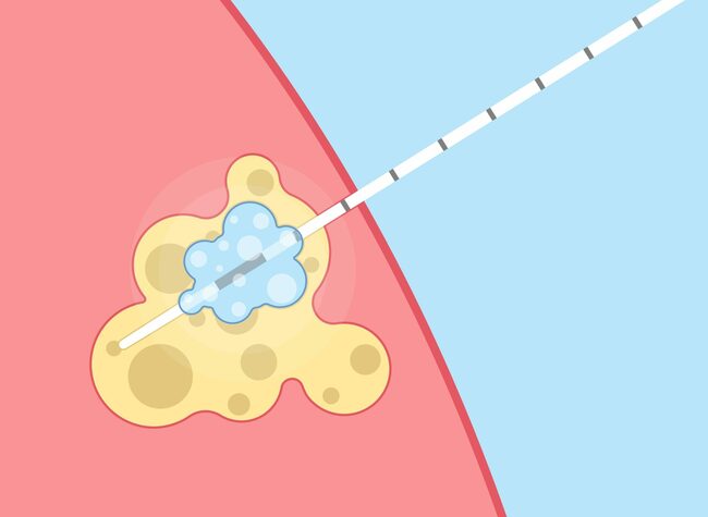 Focal Cryoablation, Stereotactic Body Radiotherapy for Prostate Cancer
