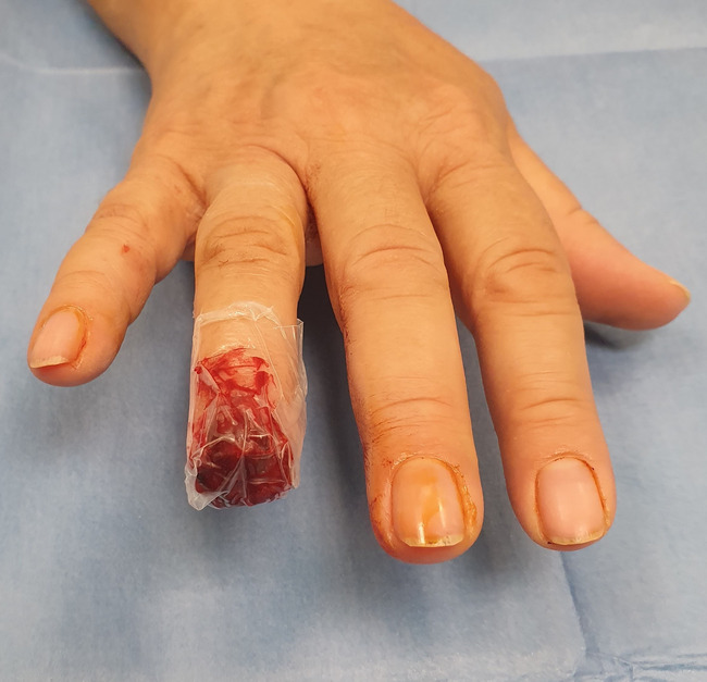 Parallelogram flaps functionally better than homodigital island flaps for fingertip reconstruction