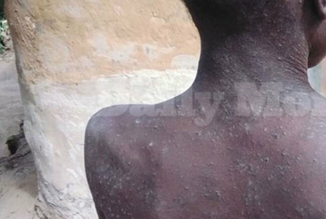 250 admitted after scabies outbreak in Pallisa